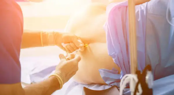 Un médico administra una epidural. Se discuten los posibles efectos secundarios de la epidural, como dolor de cabeza o entumecimiento.