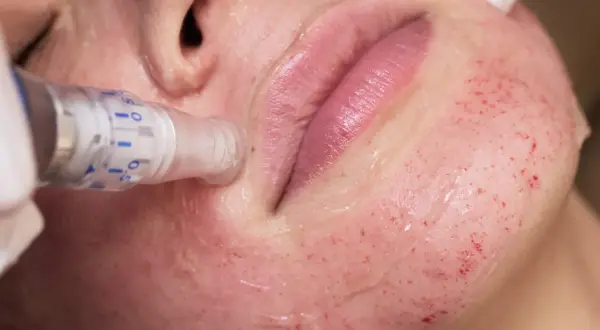 Zabieg derma peel na twarzy, widoczne drobne nakłucia i zaczerwienienie skóry.
