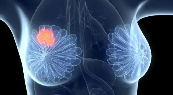 Brustkrebs-Tumor, der mit Ribociclib behandelt wird. Ribociclib ist eine Chemotherapie.