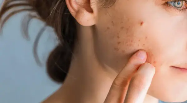 Nahaufnahme einer jungen Frau, die mit dem Finger über ihre Wange streicht, auf der rote und braune Flecken sichtbar sind, die auf Stresspickel hindeuten.