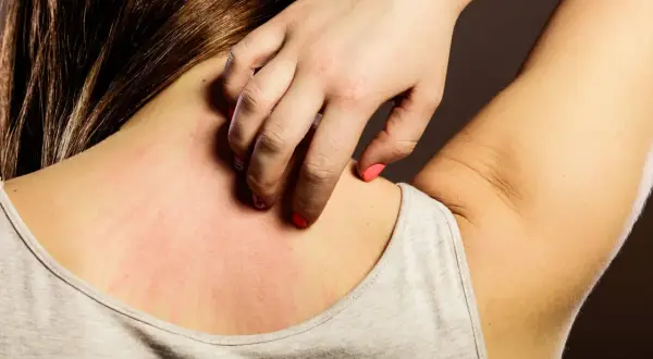 Alergia pokarmowa: Po jakim czasie objawy? Od minut do 3 dni