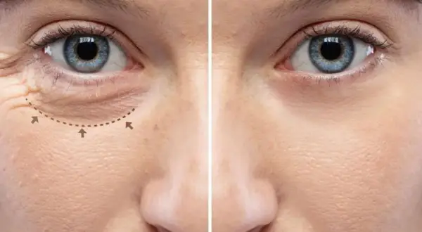 Prima e dopo: riduzione delle rughe sotto gli occhi. La pelle appare più liscia e giovane.