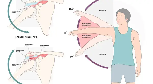 Schulter-Impingement-Syndrom: Schmerzhafter Bogen bei Armhebung zwischen 60° und 120°. Normale Schulter ohne Schmerz.