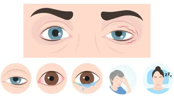 Zaczęło się od drgania powieki. Ilustracja pokazuje przyczyny: zmęczenie oczu, suchość, alergie, stres i brak snu.