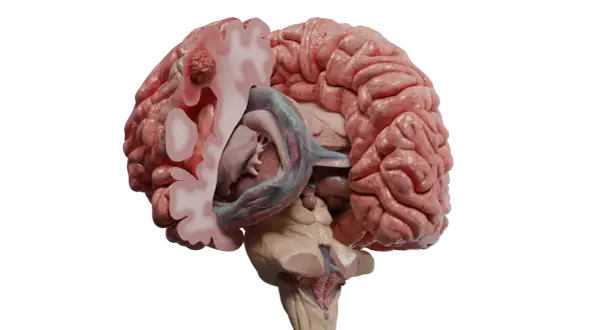 Schnitt durch ein Gehirn mit sichtbaren Metastasen im Kopf. Ein roter, knolliger Tumor wächst im linken Hirnbereich.