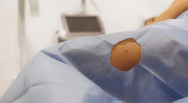 Skóra pacjenta przygotowana do zabiegu dermatochirurgii. W tle sprzęt medyczny.