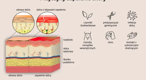 Ilustracja porównuje zdrową skórę z zapaloną, pokazując zmiany w naskórku. Wymienia też przyczyny zapalenia skóry, w tym krostkowe zapalenie skóry.