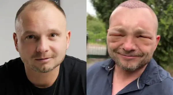 Mężczyzna po przeszczepie twarzy, z opuchniętymi powiekami i widocznymi śladami zabiegu na głowie.