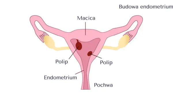 Schemat budowy macicy z widocznymi polipami w obrębie błony śluzowej macicy (endometrium).