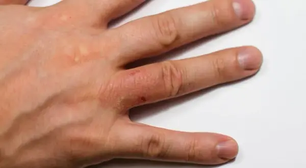 Skóra dłoni z zaczerwienieniem, łuszczeniem i pęcherzykami, objawy choroby Duhringa.