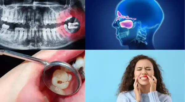 RTG szczęki, anatomia zatok, zepsuty ząb i kobieta z bólem twarzy – wszystko to może wskazywać na ból ucha od zęba.