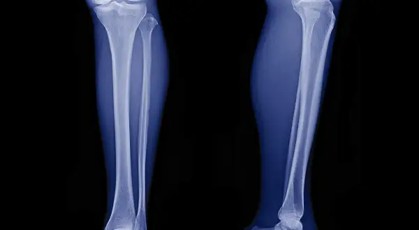 Radiografie delle gambe mostrano un fibroma ossificante, una lesione benigna che coinvolge la tibia e il perone.