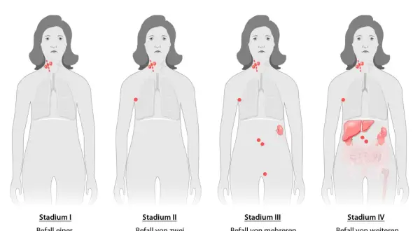 Illustrationen zeigen Stadien des Hodgkin-Lymphoms, von einem einzelnen befallenen Lymphknoten bis zu Befall mehrerer Organe. Symptome Lymphknotenkrebs können sich je nach Stadium ändern.