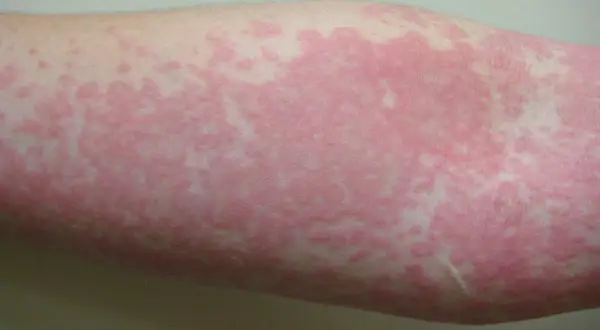 Brazo con ronchas en la piel sin picor, de color rosado y con un patrón irregular.