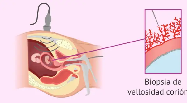 Ilustración de una biopsia corial guiada por ultrasonido, mostrando la toma de muestra de vellosidades coriónicas para análisis genético.