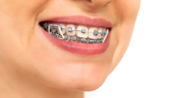Primo piano di un sorriso con apparecchio ortodontico e elastici, simbolo di un percorso verso denti perfetti.