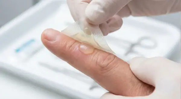 Eine kleine Brandblase am Finger wird vorsichtig mit einem transparenten Verband abgedeckt.
