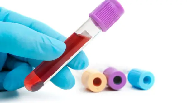 Ręka w niebieskiej rękawiczce trzyma probówkę z krwią. W tle inne probówki. Badanie hemoglobiny glikowanej - norma.