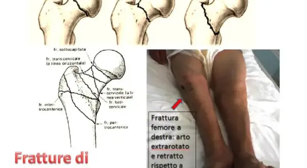 Illustrazione tipi frattura femore e gamba con frattura. La prognosi e quanto si vive dopo frattura femore dipendono da molti fattori.