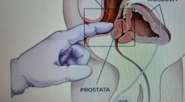Rękawiczka w ręce wykonuje masaż prostaty, co może prowadzić do orgazmu. Widoczny pęcherz moczowy i odbytnica.
