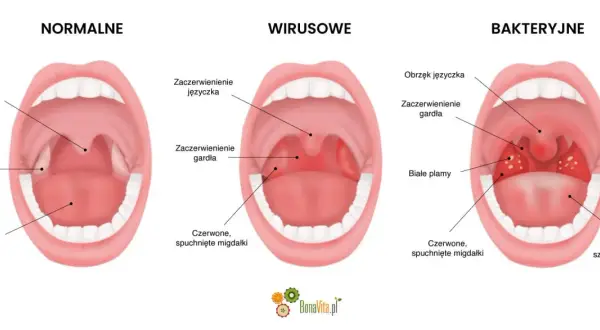 Porównanie gardła: normalne, z zaczerwienieniem języczka i gardła (angina wirusowa), oraz z białymi plamami i obrzękiem (angina bakteryjna).