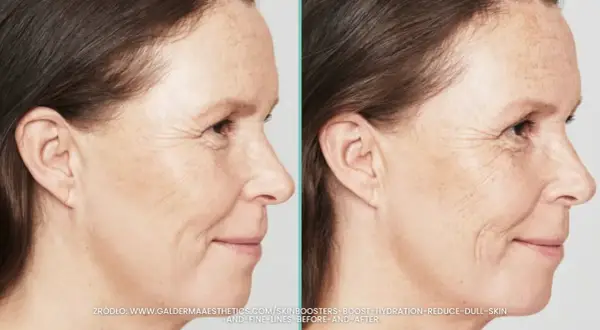 Porównanie skóry przed i po zabiegu skinbooster. Widać wygładzenie drobnych zmarszczek i poprawę nawilżenia.