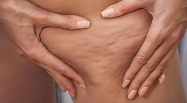 Hände greifen in die Haut und zeigen die typischen Dellen. So entsteht Cellulite.