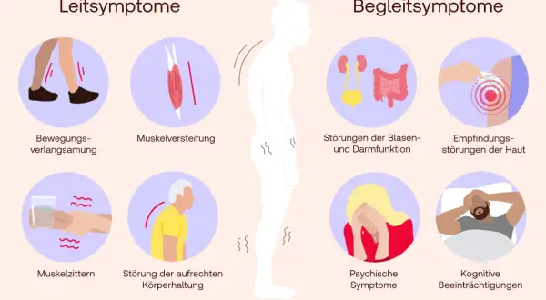 Die Grafik zeigt Symptome der Parkinson-Krankheit: Bewegungsverlangsamung, Muskelsteifheit, Zittern, Haltungsstörungen, Blasen-/Darmprobleme, Hautempfindungsstörungen, psychische und kognitive Beeinträchtigungen.