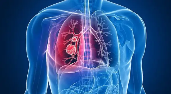 Menschliche Lunge mit einem roten Tumor, der Lungenkrebs darstellt. Das Alter spielt eine Rolle bei der Entstehung.