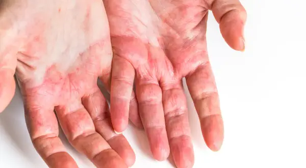 Mani con arrossamento e secchezza, sintomi di dermatite da contatto. Si cercano rimedi efficaci per alleviare il prurito e l'irritazione.