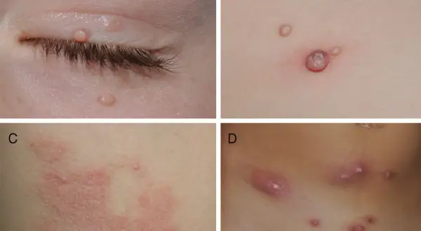 Lesiones de molusco contagioso en la piel de niños. A: párpado. B: tronco. C: tronco con inflamación. D: abdomen.