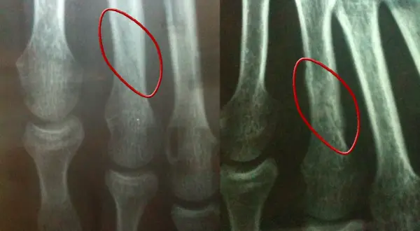 Radiographie du pied montrant une fracture du 4ème métatarsien droit, jour de la fracture et J+45. La guérison prend du temps.