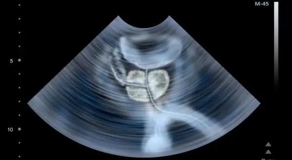 Badanie prostaty per rectum: Bez obaw! Przewodnik krok po kroku