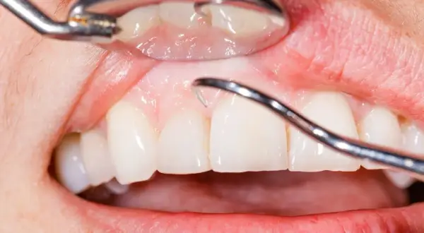 Ropa z zęba? Co pomoże i dlaczego musisz iść do dentysty!