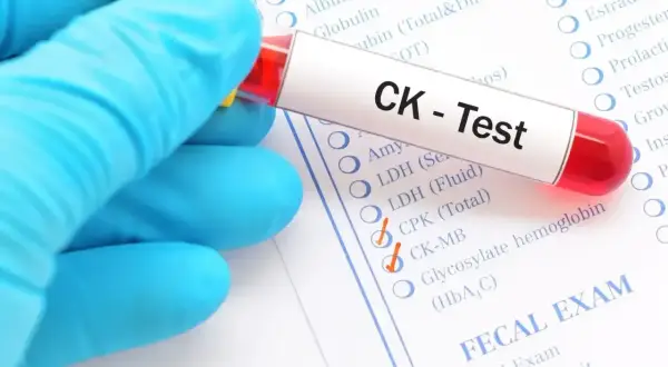 Rękawiczka w niebieskiej rękawiczce trzyma probówkę z krwią do testu CK. Wyniki badań mogą pomóc zdiagnozować podwyższona kinaza kreatynowa objawy.
