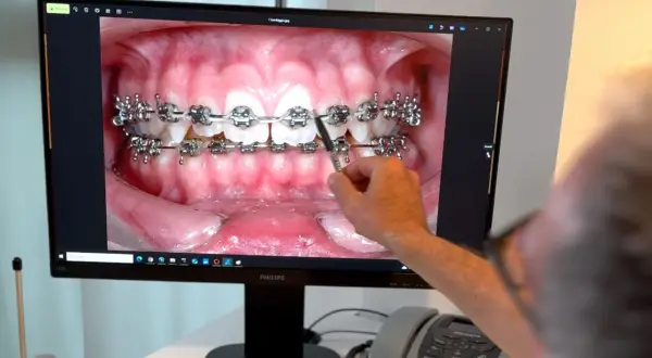 Primo piano di un monitor che mostra un primo piano di denti con apparecchio fisso trasparente. Una mano indica i denti.