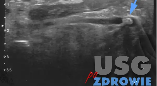 USG obrazujące kamicę ślinianek. Widoczny kamień w przewodzie ślinianki, wskazany niebieską strzałką.