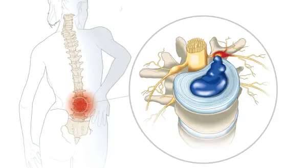 Illustration d'une discopathie lombaire causant une douleur la nuit, avec un disque intervertébral hernié comprimant un nerf.