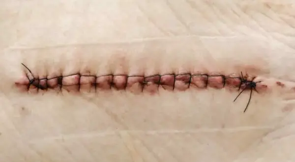 Gros plan d'une plaie suturée, où un fil de suture reste dans la plaie, témoignant du processus de guérison.