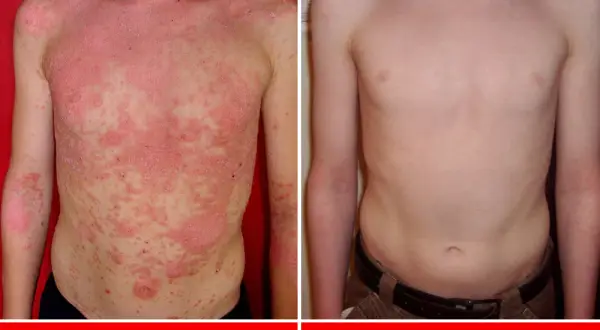 Łuszczyca: Metody leczenia w Polsce od maści po terapie biologiczne