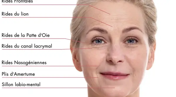 Visage d'une femme montrant les rides frontales, du lion, pattes d'oie, nasogéniennes, plis d'amertume et sillon labio-mental.