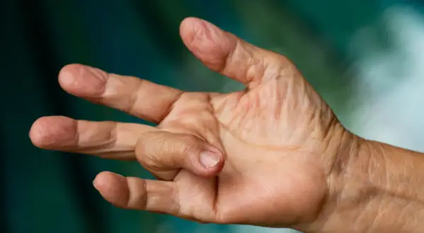 Eine Hand mit einem verdickten Finger, der sich nicht ganz strecken lässt. Dies kann ein Symptom für einen Schnappfinger sein, dessen Ursache oft eine Sehnenscheidenentzündung ist.
