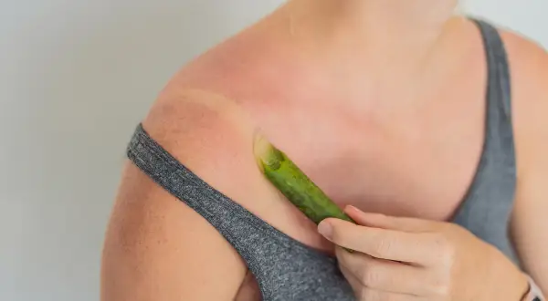 Donna applica gel di aloe vera su una scottatura solare, sfruttando i benefici per la pelle.