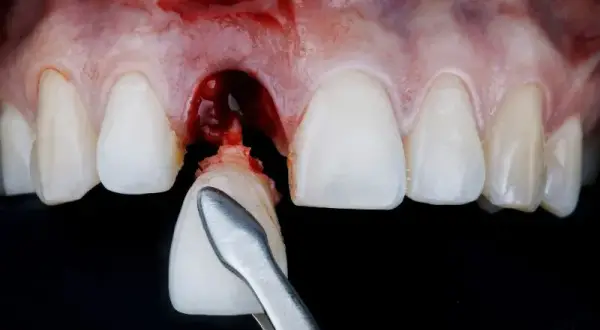 Krwawienie po wyrwaniu zęba: co jest normą, a kiedy do dentysty?