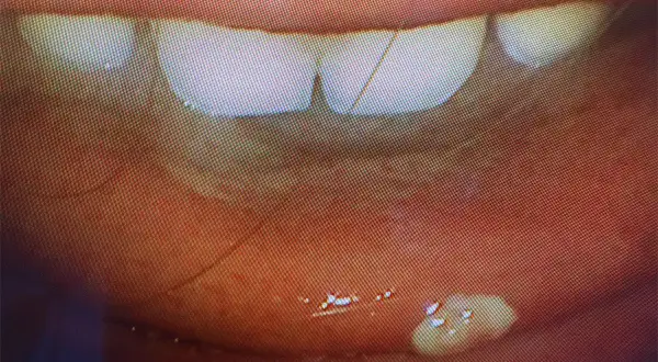 Nahaufnahme der Lippen und Zähne. Kleine, weiße Flecken auf der Innenseite der Lippe, die auf eine HPV-Infektion im Mund hindeuten könnten.