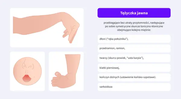 Tężyczka jawna to objawy skurczów mięśni, np. dłoni ("ręka położnika"), twarzy ("usta karpia") czy kończyn.