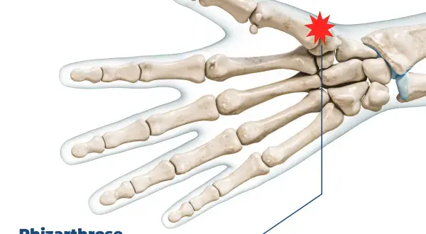 Skelett der Hand mit hervorgehobenem Daumengrundgelenk, das auf Schmerzen im Daumengelenk durch Rhizarthrose hinweist.