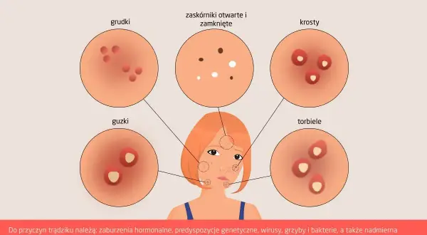 Ilustracja przedstawia różne rodzaje zaskórników i wyprysków trądzikowych: grudki, guzki, zaskórniki otwarte i zamknięte, krosty i torbiele.