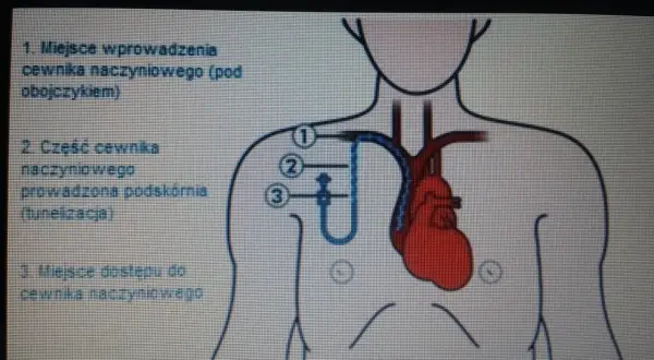 Schemat przedstawia umiejscowienie portu naczyniowego. Cewnik wprowadzany jest pod obojczykiem, prowadzony podskórnie, a następnie trafia do naczynia.