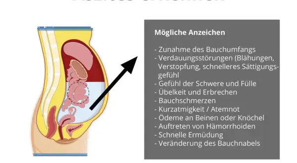 Illustration zeigt Bauchraum mit Flüssigkeitsansammlung. Symptome wie Bauchumfangszunahme und Völlegefühl deuten auf Wasser im Bauch hin.